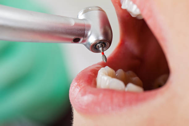 Best Emergency Dental Care for Abscessed Tooth in Pendleton, OR